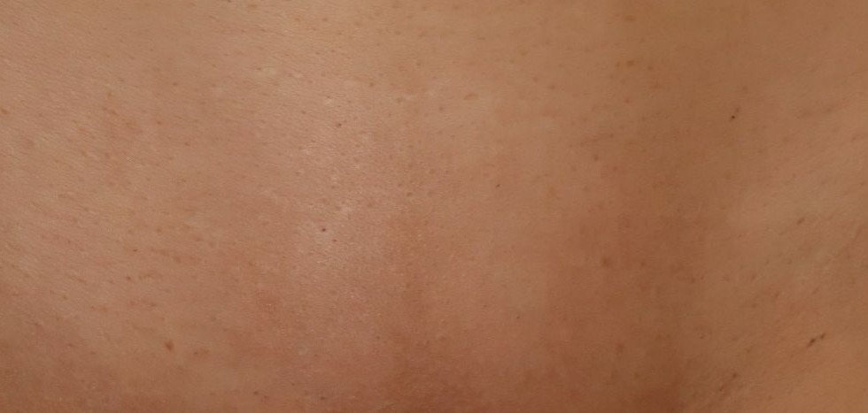 pielea dupa epilare definitiva