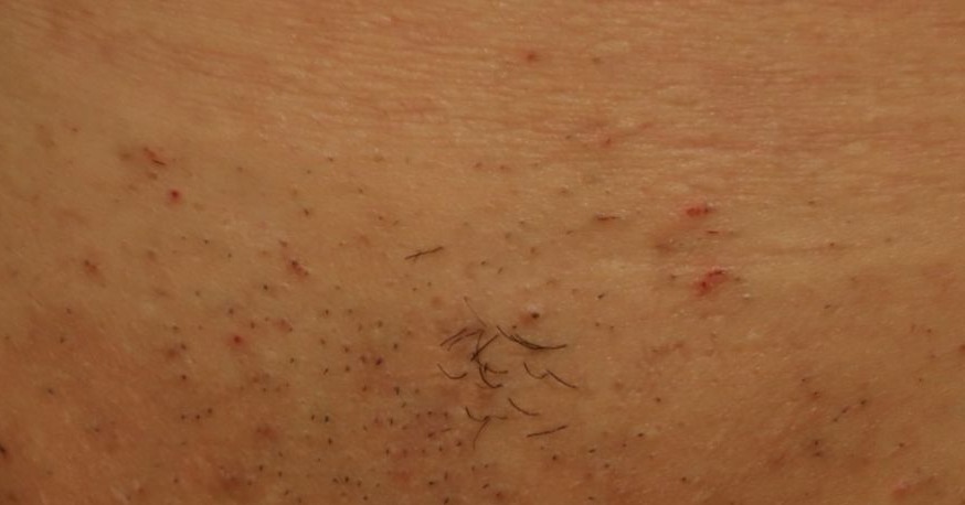 inainte de epilare cu laser